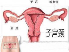 宫颈炎的危害有哪些