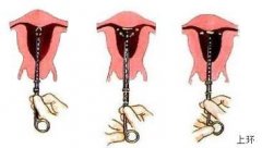 上环前需要做哪些检查？注意事项有哪些